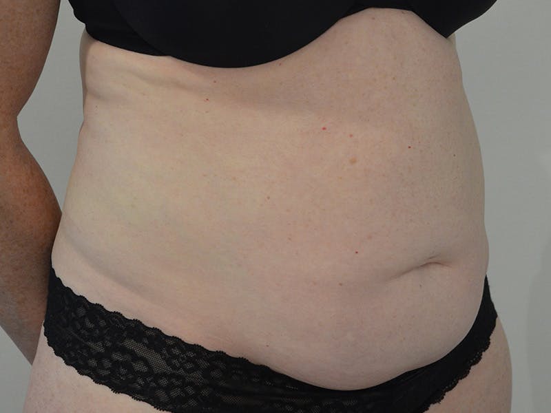 Tummy Tuck Before & After Gallery - Patient 774732 - Image 3
