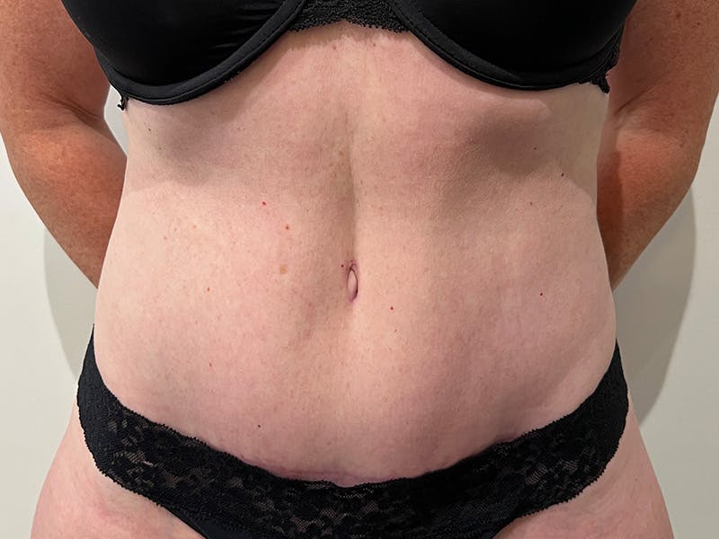 Tummy Tuck Before & After Gallery - Patient 774732 - Image 2