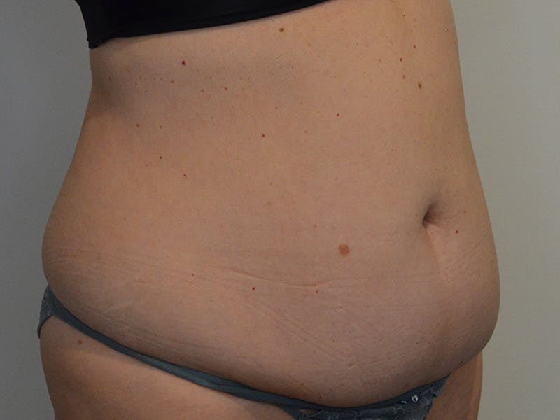 Tummy Tuck Before & After Gallery - Patient 223600 - Image 3