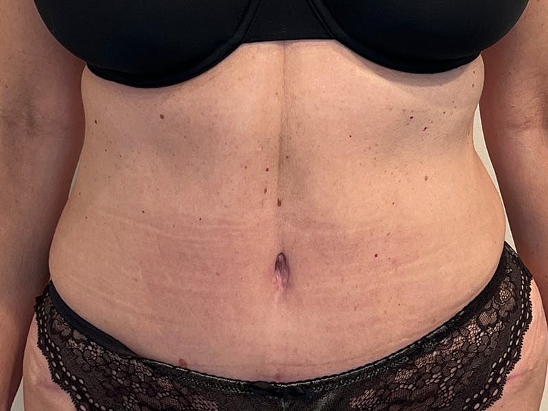 Tummy Tuck Before & After Gallery - Patient 223600 - Image 2
