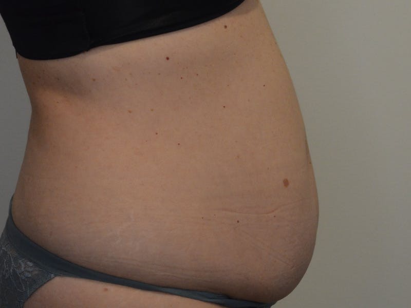 Tummy Tuck Before & After Gallery - Patient 223600 - Image 5
