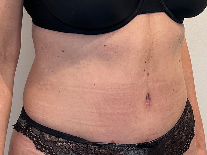 Tummy Tuck Before & After Gallery - Patient 223600 - Image 4