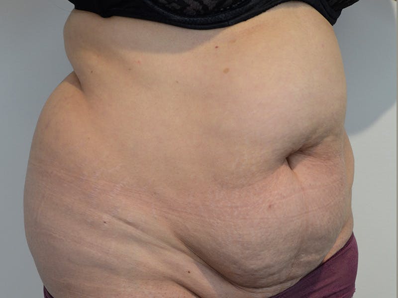 Tummy Tuck Before & After Gallery - Patient 165527 - Image 3
