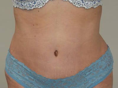 Liposuction Before & After Gallery - Patient 107590 - Image 2