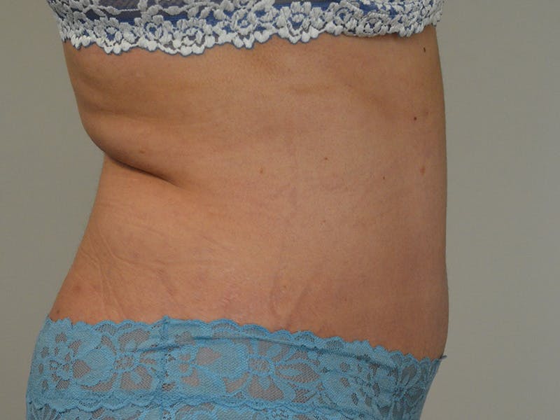Tummy Tuck Before & After Gallery - Patient 165527 - Image 6