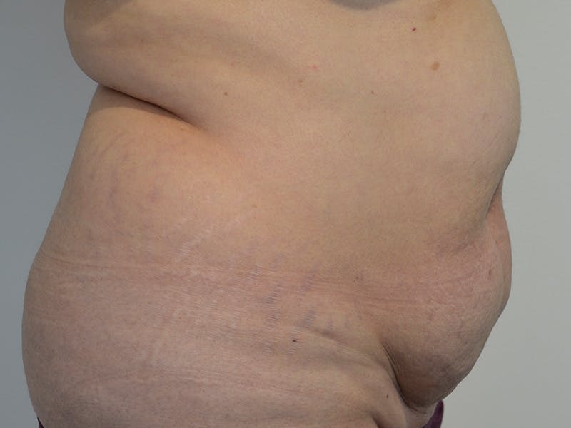 Tummy Tuck Before & After Gallery - Patient 165527 - Image 5
