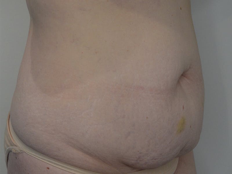 Tummy Tuck Before & After Gallery - Patient 661598 - Image 3