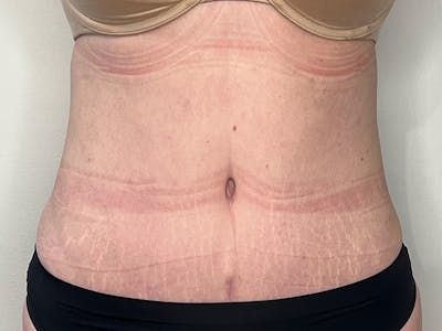 Liposuction Before & After Gallery - Patient 498244 - Image 2