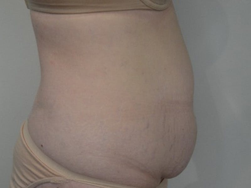 Tummy Tuck Before & After Gallery - Patient 661598 - Image 5