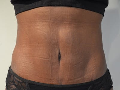 Liposuction Before & After Gallery - Patient 642819 - Image 2