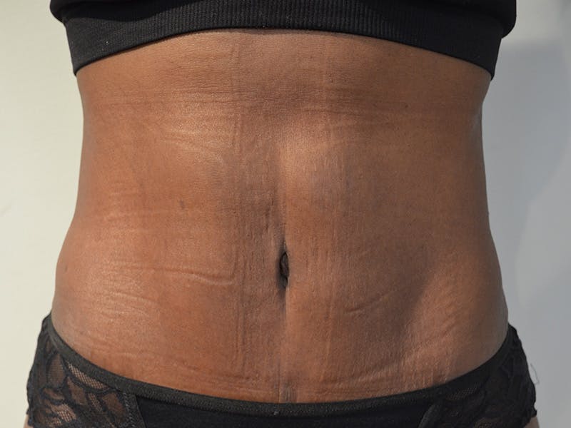 Tummy Tuck Before & After Gallery - Patient 379374 - Image 2