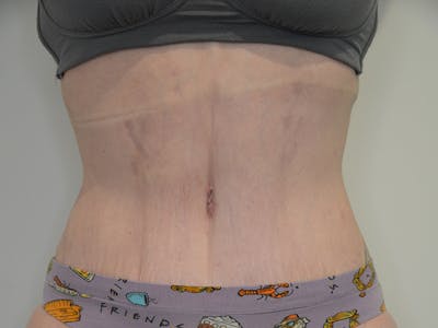 Liposuction Before & After Gallery - Patient 584710 - Image 2