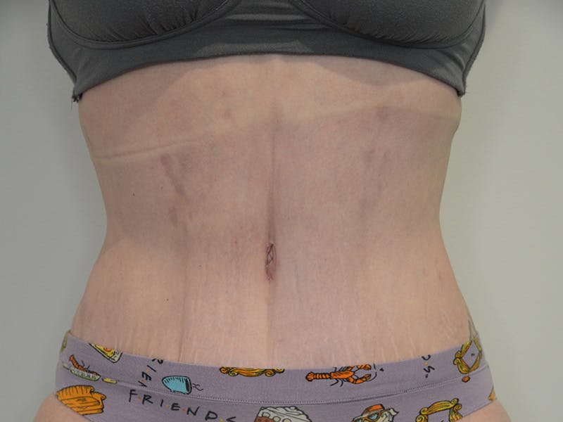 Tummy Tuck Before & After Gallery - Patient 419947 - Image 2