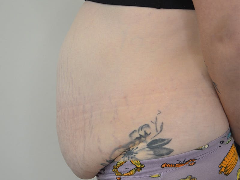 Tummy Tuck Before & After Gallery - Patient 419947 - Image 5