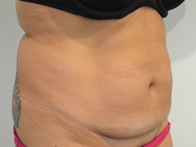 Liposuction Before & After Gallery - Patient 386224 - Image 3