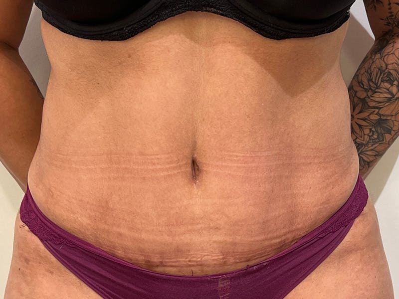 Liposuction Before & After Gallery - Patient 386224 - Image 2