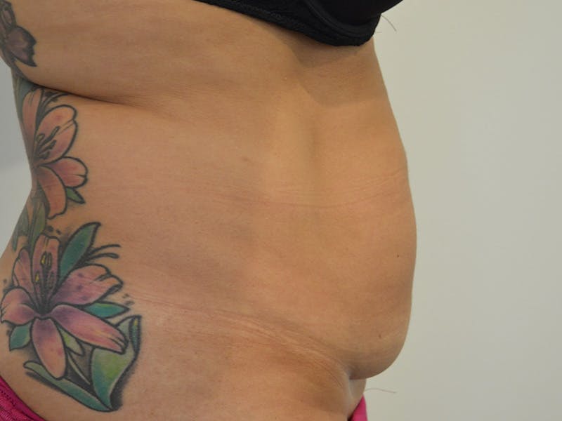 Liposuction Before & After Gallery - Patient 386224 - Image 5