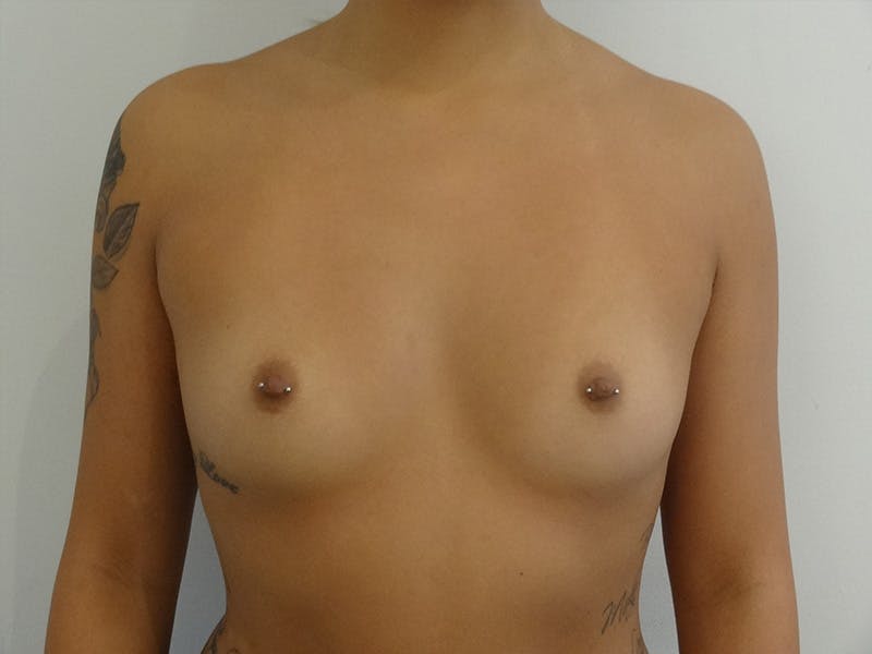 Breast Augmentation Before & After Gallery - Patient 268599 - Image 1