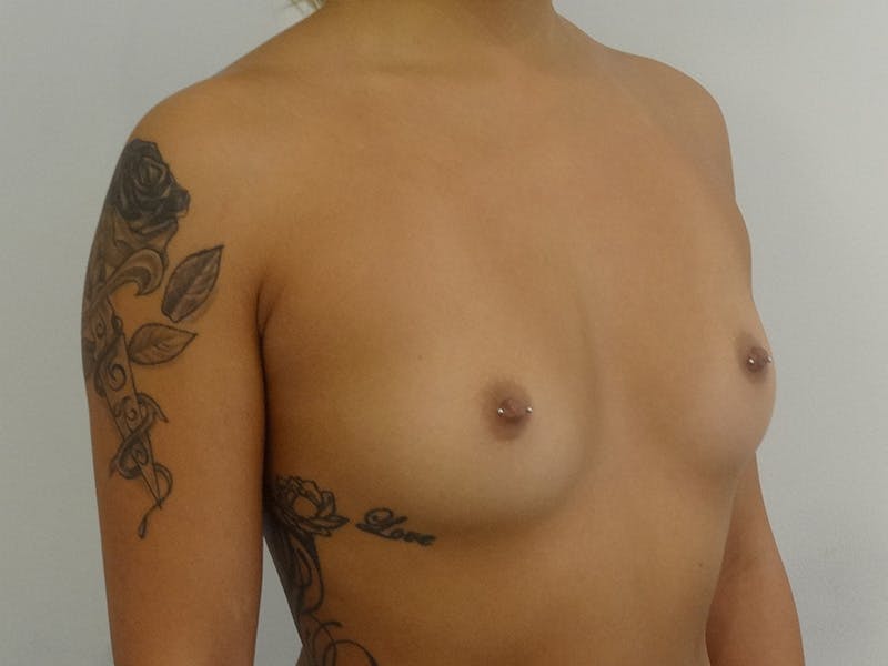 Breast Augmentation Before & After Gallery - Patient 268599 - Image 3