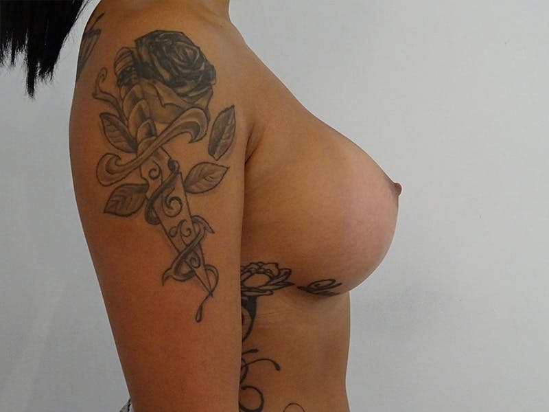 Breast Augmentation Before & After Gallery - Patient 268599 - Image 6