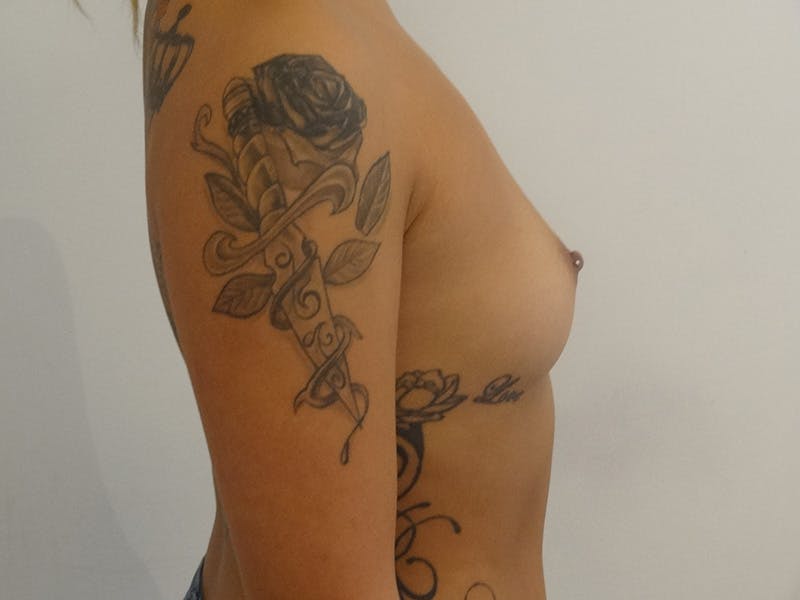 Breast Augmentation Before & After Gallery - Patient 268599 - Image 5