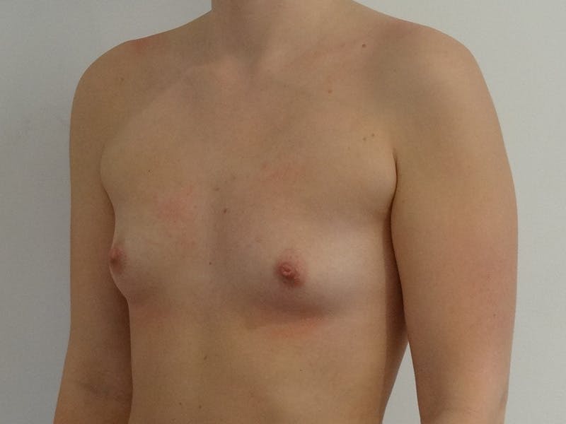 Breast Augmentation Before & After Gallery - Patient 106360 - Image 3