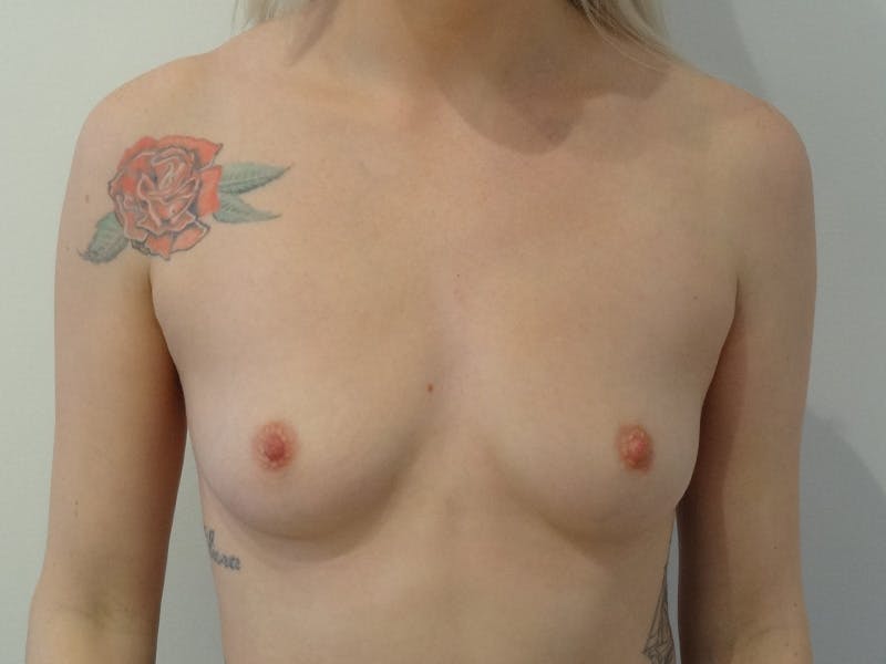 Breast Augmentation Before & After Gallery - Patient 231627 - Image 1