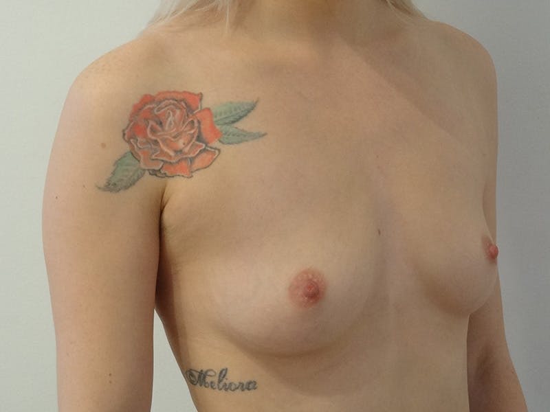 Breast Augmentation Before & After Gallery - Patient 231627 - Image 3