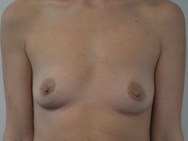 Breast Augmentation Before & After Gallery - Patient 312624 - Image 1