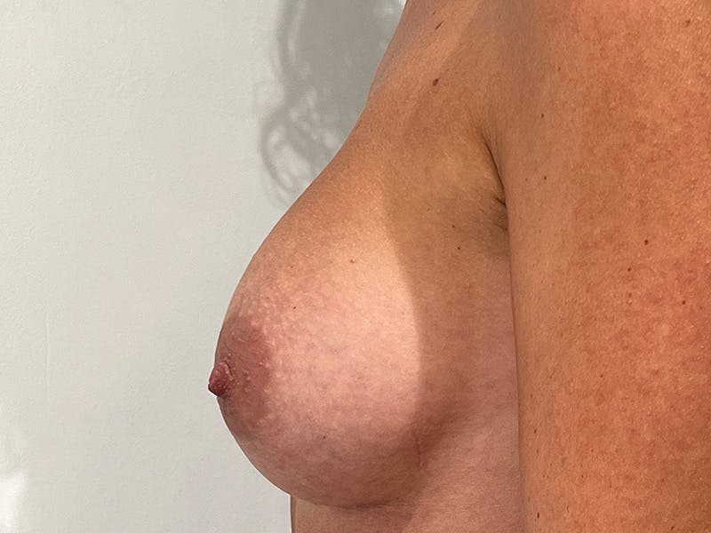 Breast Augmentation Before & After Gallery - Patient 312624 - Image 6