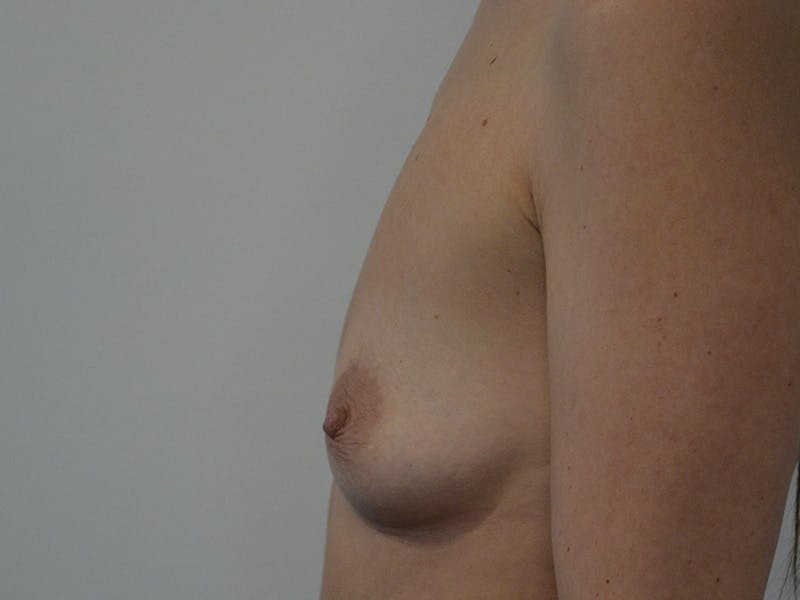 Breast Augmentation Before & After Gallery - Patient 312624 - Image 5