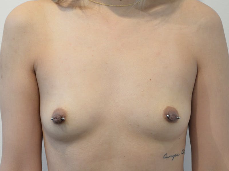 Breast Augmentation Before & After Gallery - Patient 379277 - Image 1