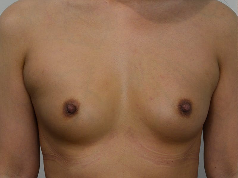 Breast Augmentation Before & After Gallery - Patient 135055 - Image 1