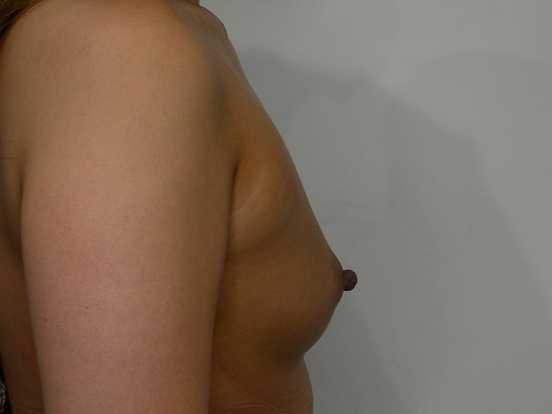 Breast Augmentation Before & After Gallery - Patient 135055 - Image 5