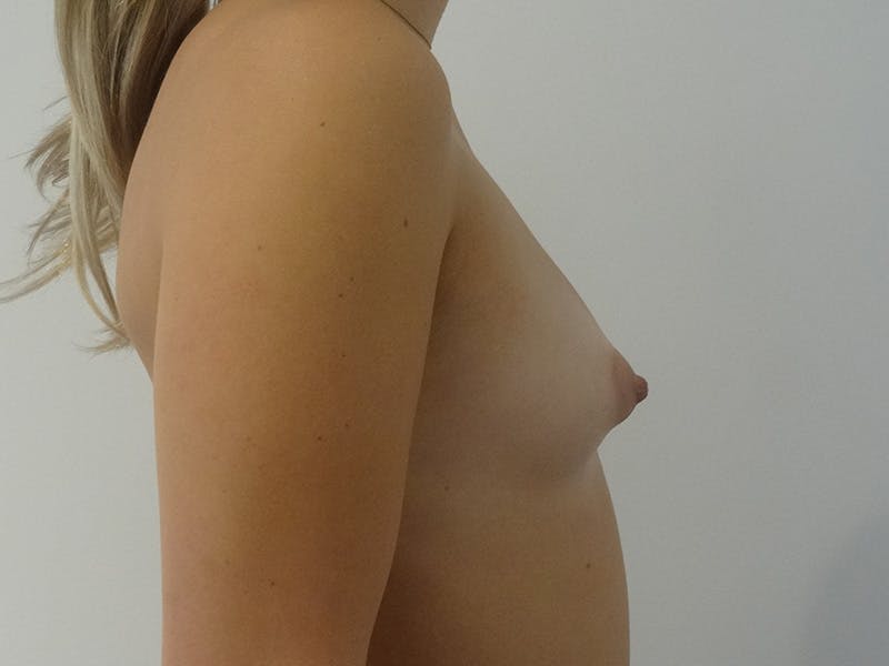Breast Augmentation Before & After Gallery - Patient 268076 - Image 5