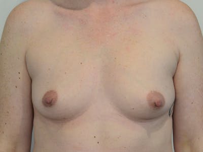 Breast Augmentation Before & After Gallery - Patient 462206 - Image 1