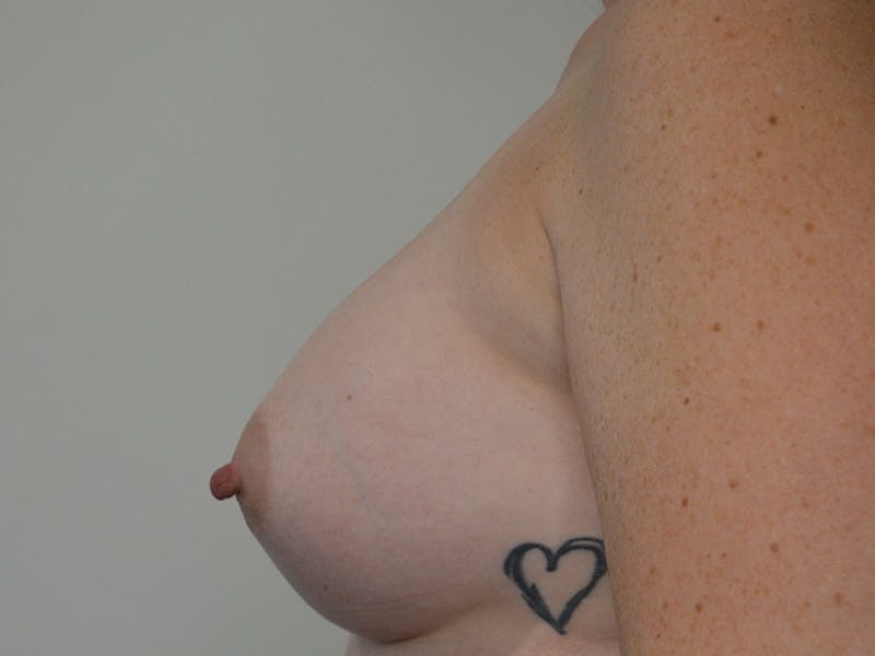 Breast Augmentation Before & After Gallery - Patient 462206 - Image 6