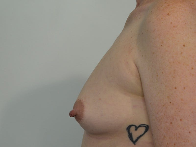 Breast Augmentation Before & After Gallery - Patient 462206 - Image 5