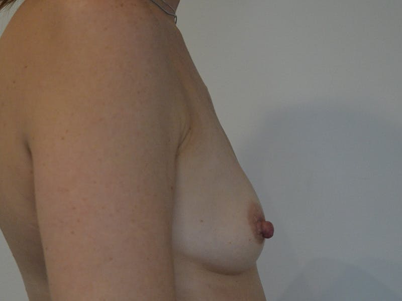 Breast Augmentation Before & After Gallery - Patient 244990 - Image 5