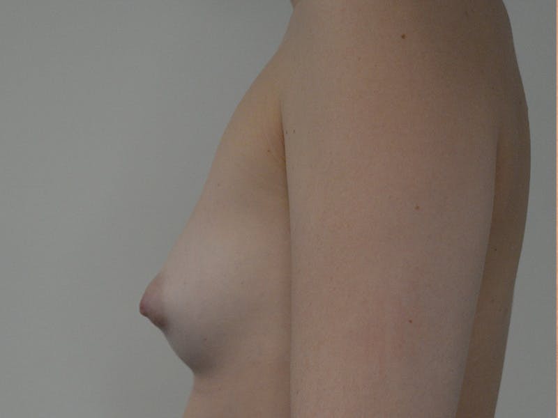 Breast Augmentation Before & After Gallery - Patient 247660 - Image 5