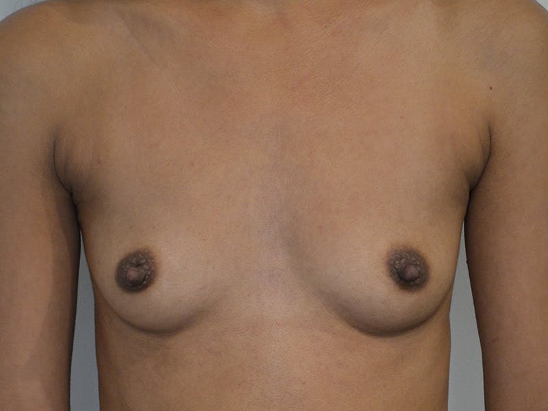 Breast Augmentation Before & After Gallery - Patient 421049 - Image 1