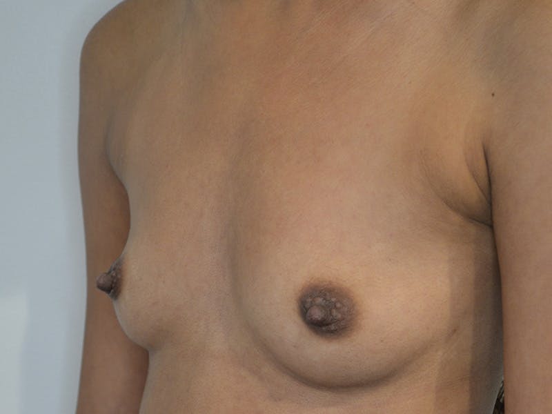 Breast Augmentation Before & After Gallery - Patient 421049 - Image 3