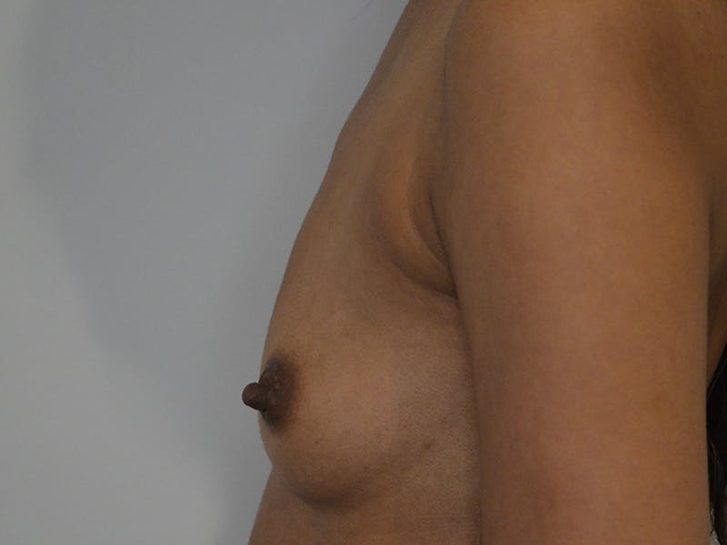 Breast Augmentation Before & After Gallery - Patient 421049 - Image 5