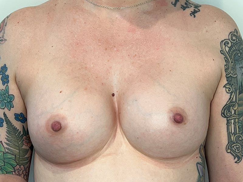 Breast Augmentation Before & After Gallery - Patient 234178 - Image 2
