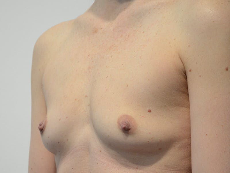Breast Augmentation Before & After Gallery - Patient 149555 - Image 3