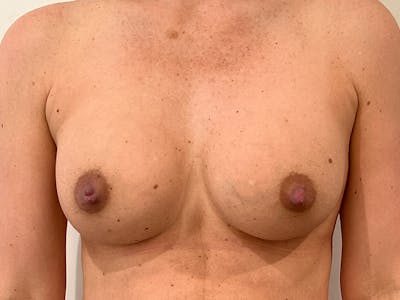Breast Augmentation Before & After Gallery - Patient 149555 - Image 2