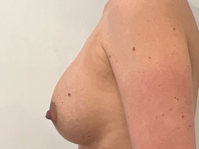 Breast Augmentation Before & After Gallery - Patient 149555 - Image 6