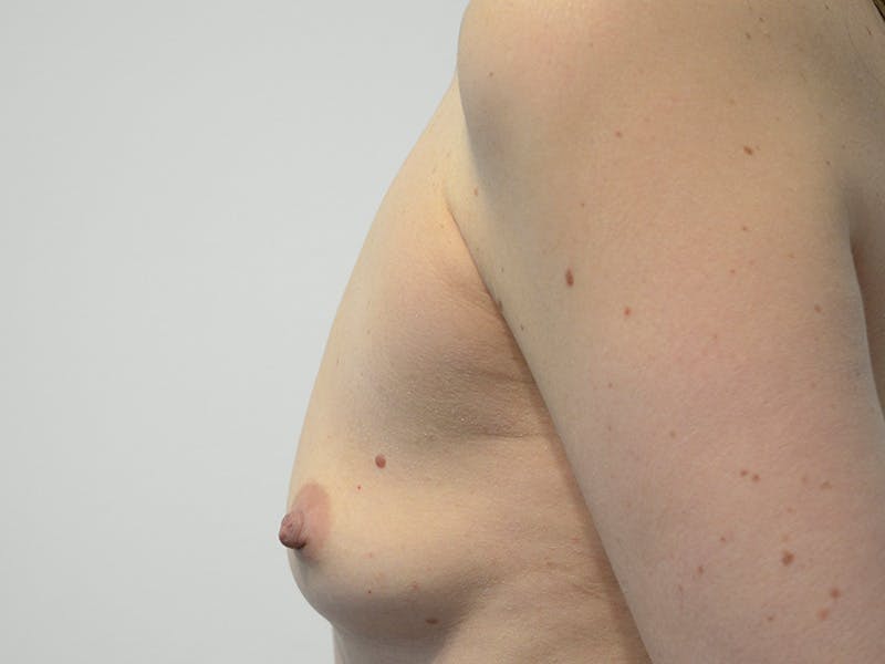 Breast Augmentation Before & After Gallery - Patient 149555 - Image 5
