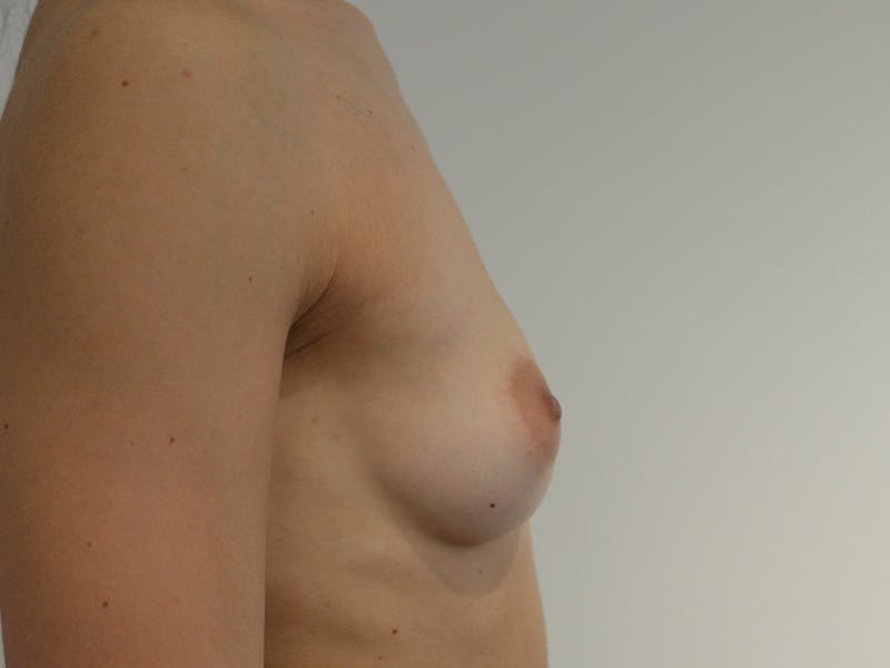 Breast Augmentation Before & After Gallery - Patient 210740 - Image 5