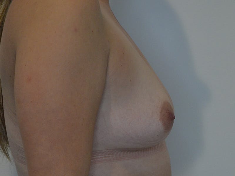 Breast Augmentation Before & After Gallery - Patient 784168 - Image 5